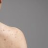 Cicatrices de acné, ABC para prevenirlas y tratarlas