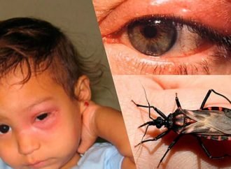 TODO SOBRE LA ENFERMEDAD DE CHAGAS