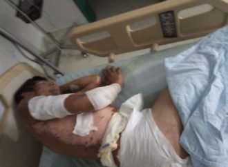 Habitante de calle sufrió quemaduras en el 60% de su cuerpo