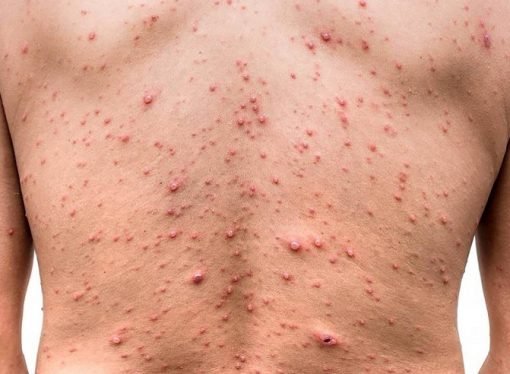 OMS declara emergencia sanitaria internacional por Viruela del mono