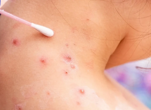 La viruela del mono llegará a Casanare?