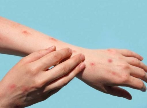 Se confirma el primer caso de viruela del mono en Casanare