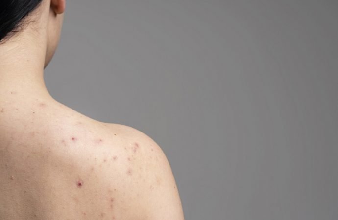 Cicatrices de acné, ABC para prevenirlas y tratarlas